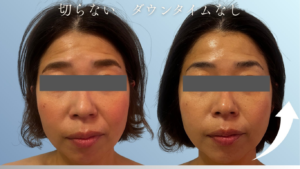 KIWAMI小顔コースでのビフォーアフター