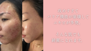 ニキビが多発してしまう肌でも綺麗になれます。
