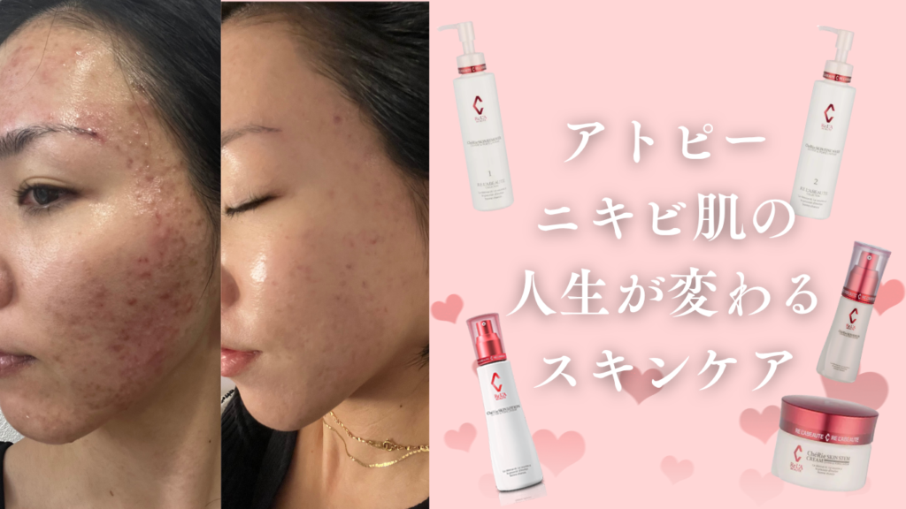 何をやっても改善しない、ニキビやアトピーに悩まされていませんか？